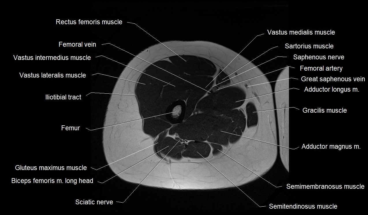 MRI thigh cross sectional anatomy image 24.webp